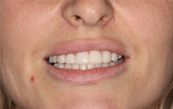 After - Hunts Cross Dental Centre