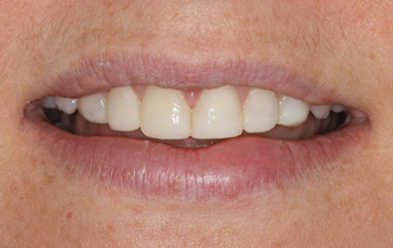After - Hunts Cross Dental Centre